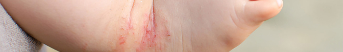 Comment soigner le psoriasis des pieds ?